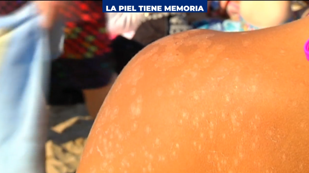 La piel tiene memoria