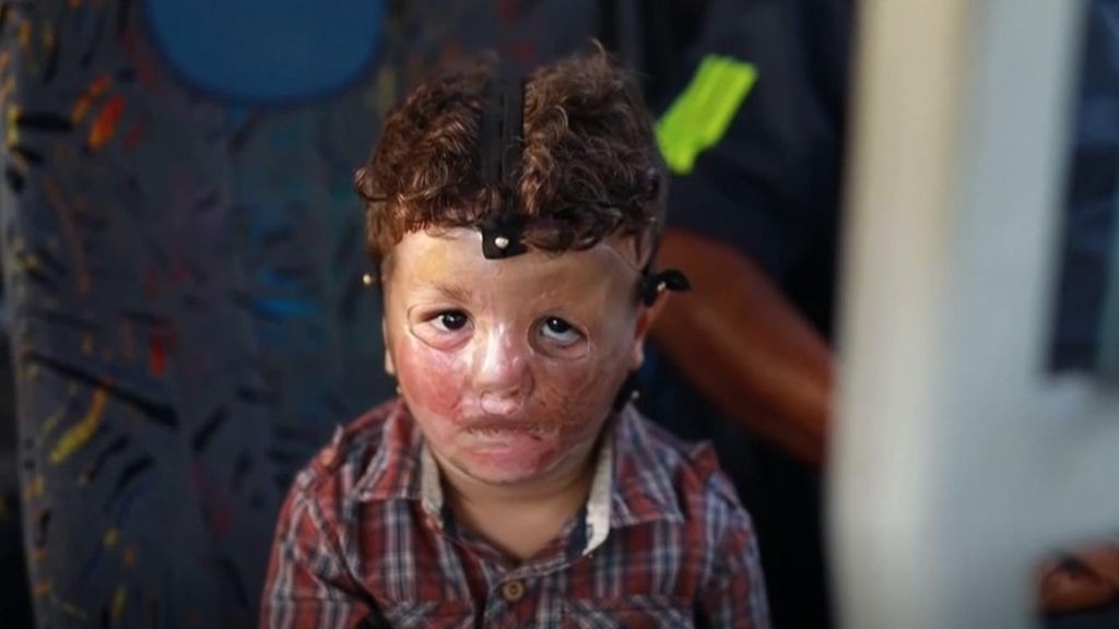 Sanad, un niño gazatí herido por un misil con el 25% de su cuerpo quemado que ha sido evacuado desde la Franja