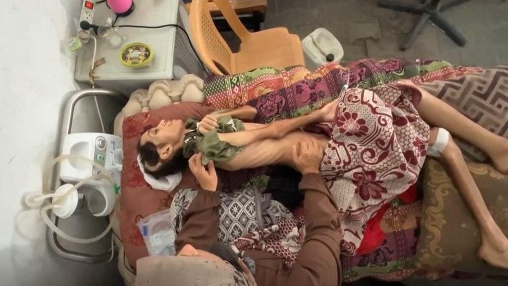 Mosab, un niño gazatí que ha perdido hasta 30 kilos de peso desde que comenzó la guerra