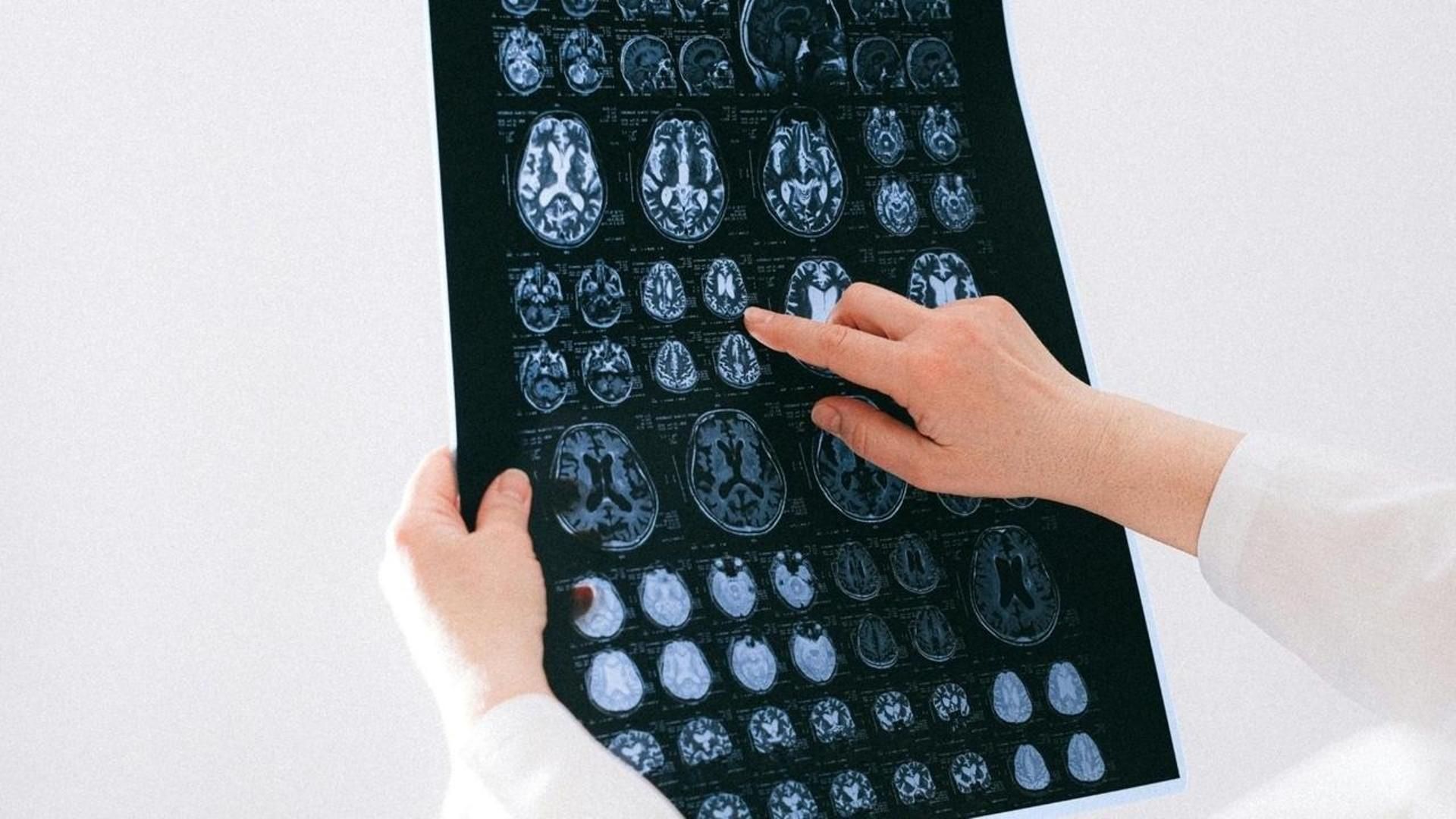 Identifican un patrón en la actividad cerebral que "predice qué pacientes tienen mayor probabilidad de desarrollar alzhéimer"