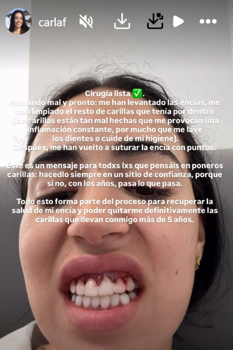 Carla Flila enseña sus encías ensangrentadas tras su intervención dental