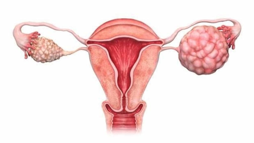 Imagen de archivo del cáncer de ovarios