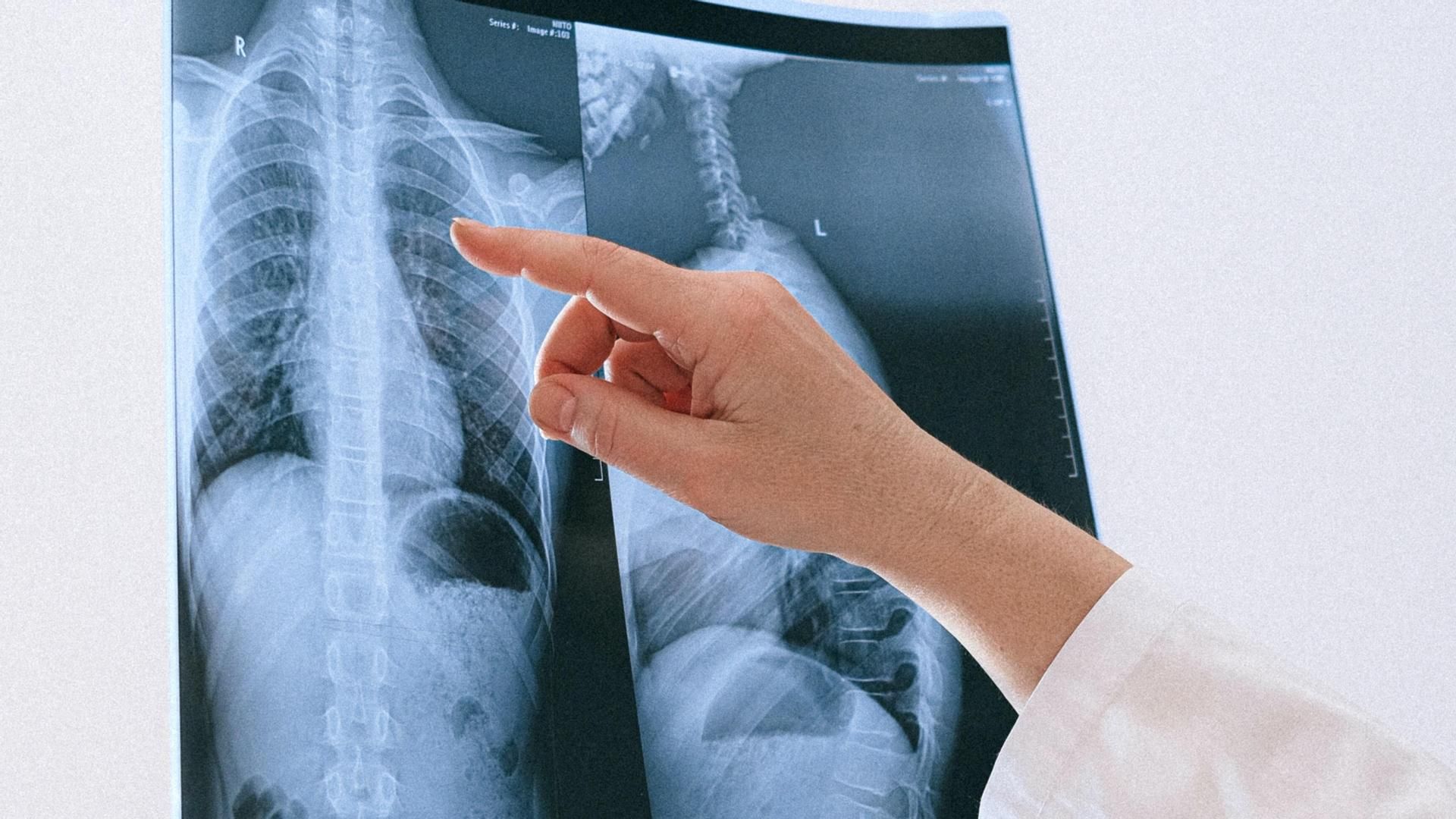 Las mujeres tienen un 50% más de probabilidades que los hombres de desarrollar enfermedades pulmonares crónicas, según un estudio