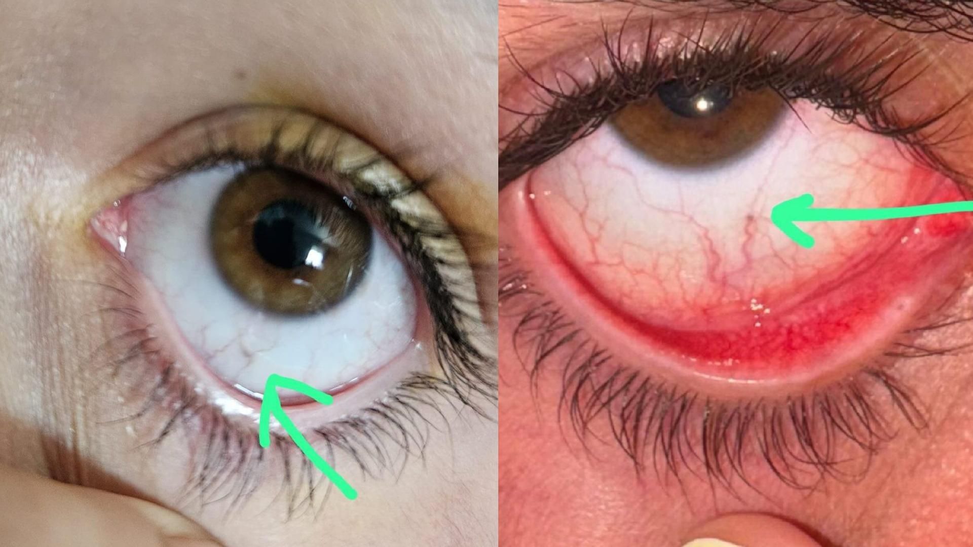 Afectados con pequeñas virutas metálicas en los ojos