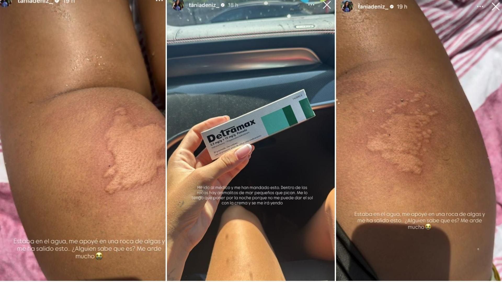 La reacción alérgica que Tania Déniz sufrió tras apoyarse en una roca con algas