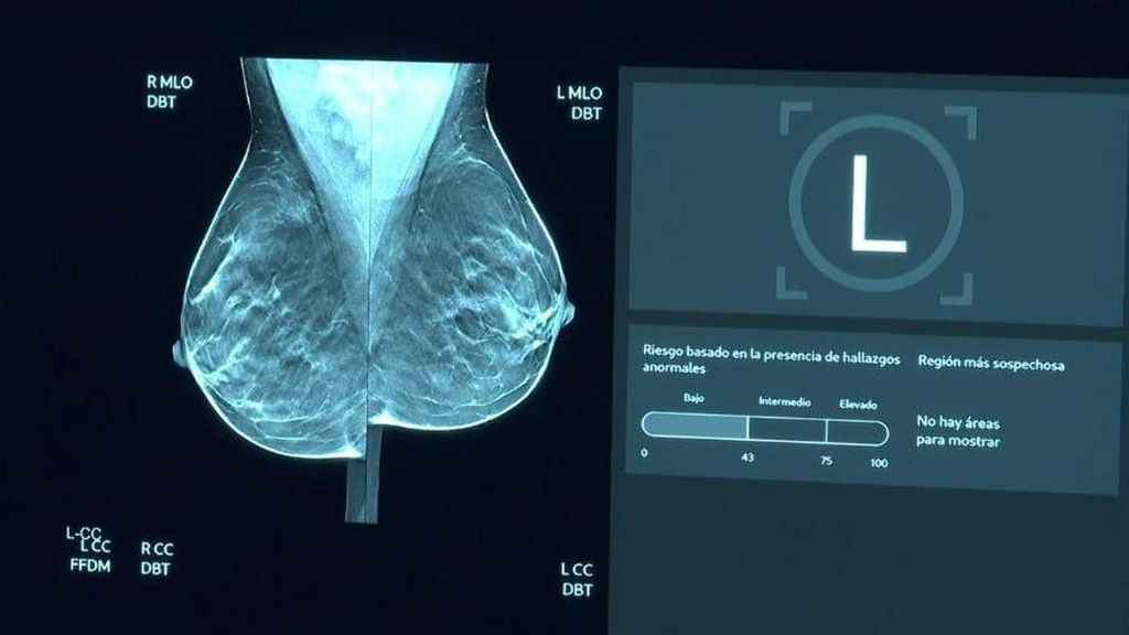 La Inteligencia Artificial, nueva aliada de los radiólogos en la detección precoz del cáncer por su análisis veloz de mamografías