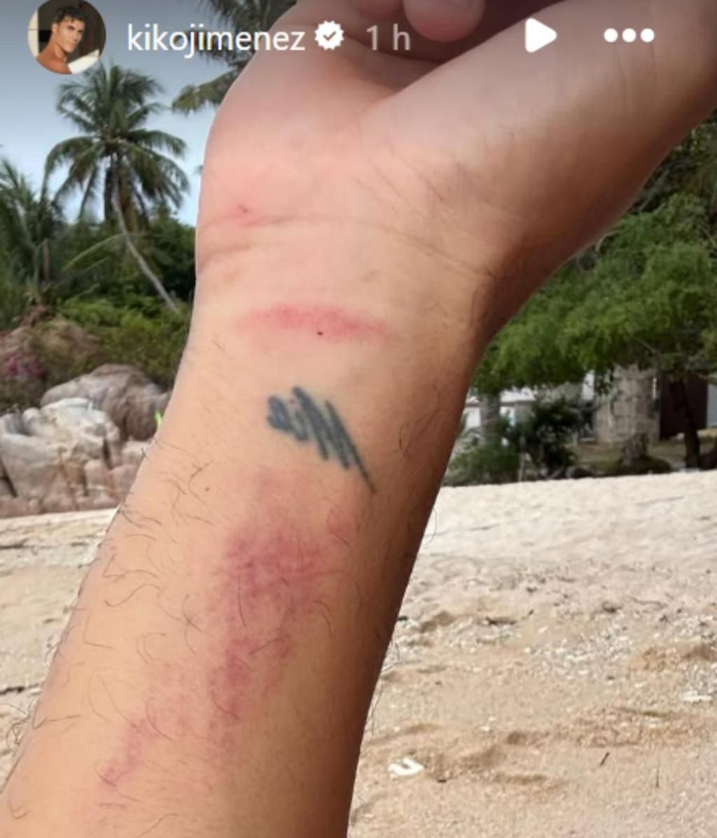 Las secuelas de Kiko Jiménez