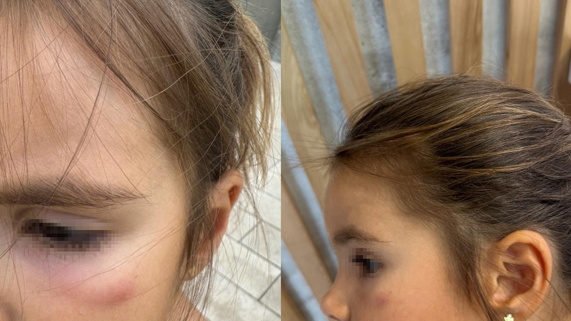 Ivana Icardi enseña el ojo inflamado de su hija