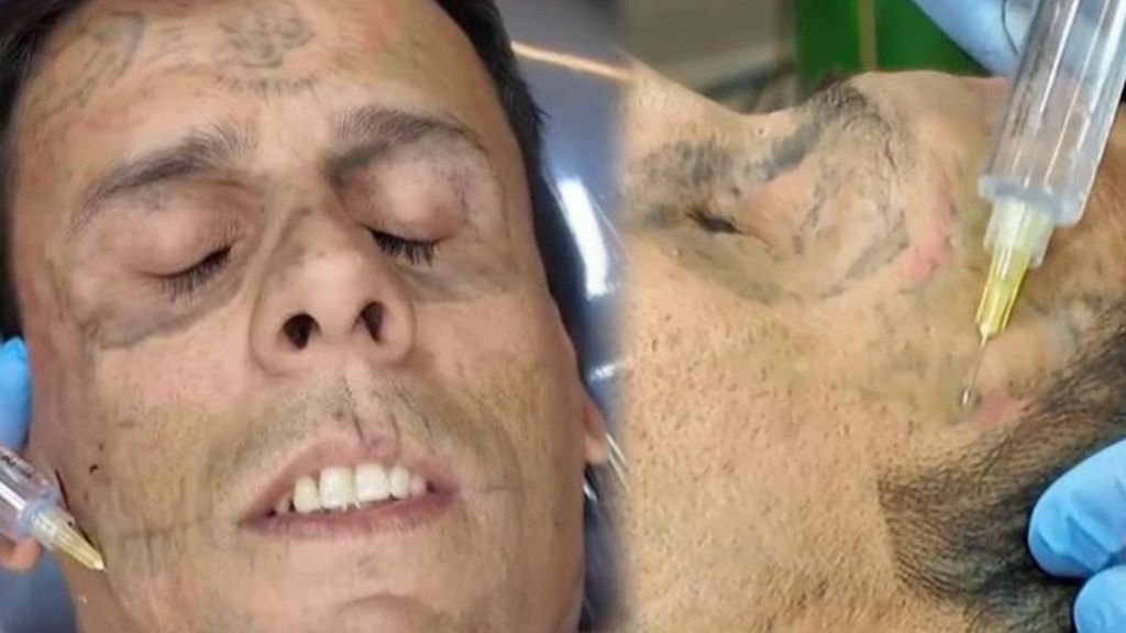Una experta habla del doloroso proceso al que se somete el hombre más tatuado del mundo, para borrar toda la tinta de su cuerpo: "El cuerpo tiene que regenerarse"