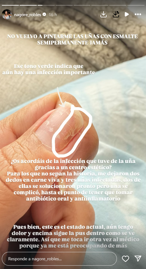 Nagore Robles muestra la infección que se le ha hecho en el dedo tras pintarse las uñas con esmalte semipermanente
