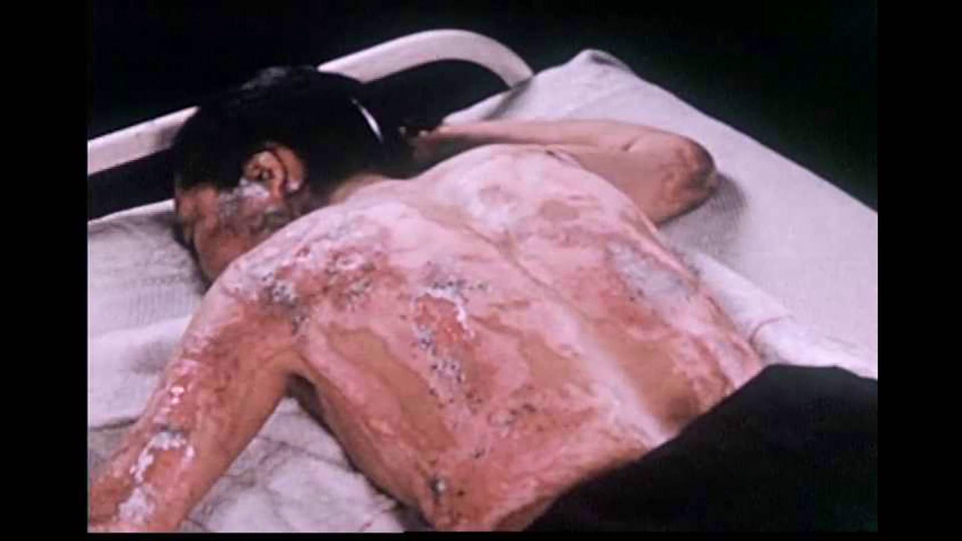 Herido por la bomba atómica en Hiroshima