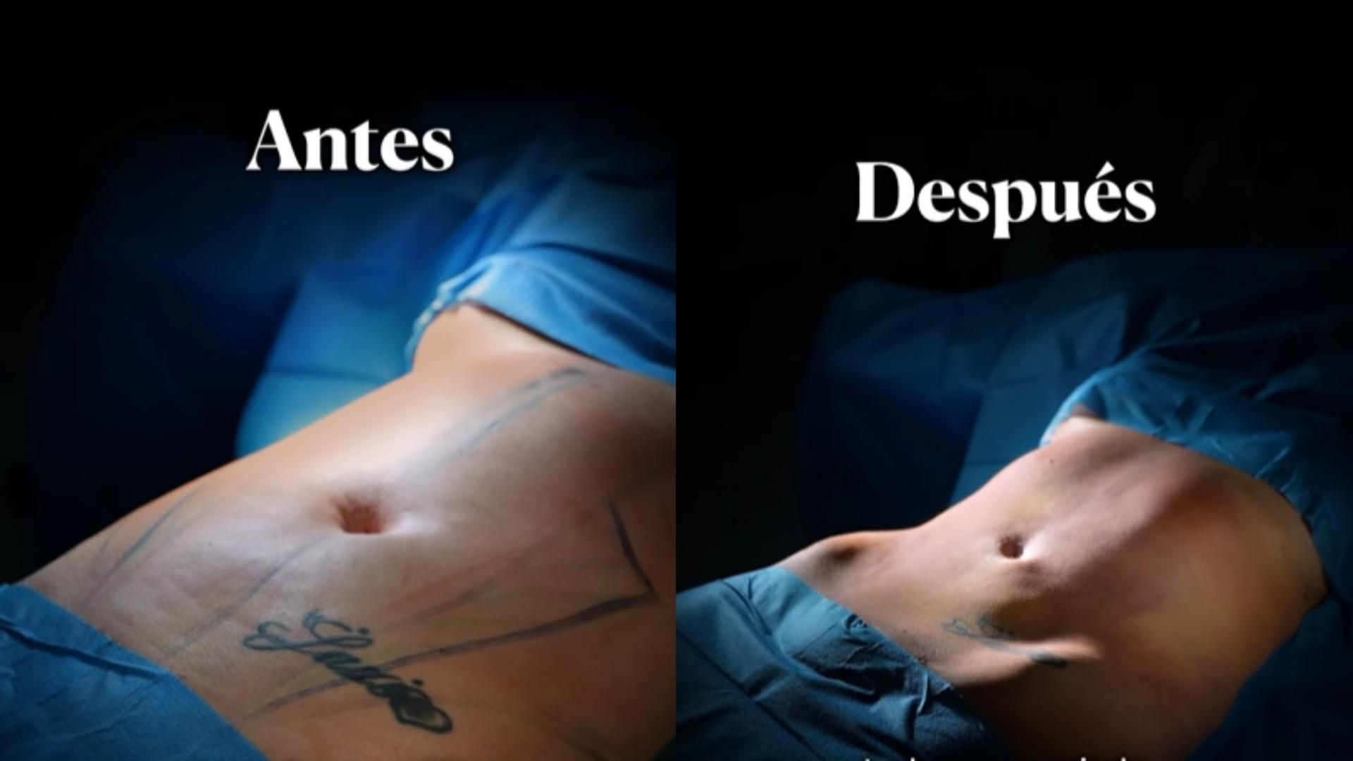 El antes y el después del abdomen de Vanessa Bouza