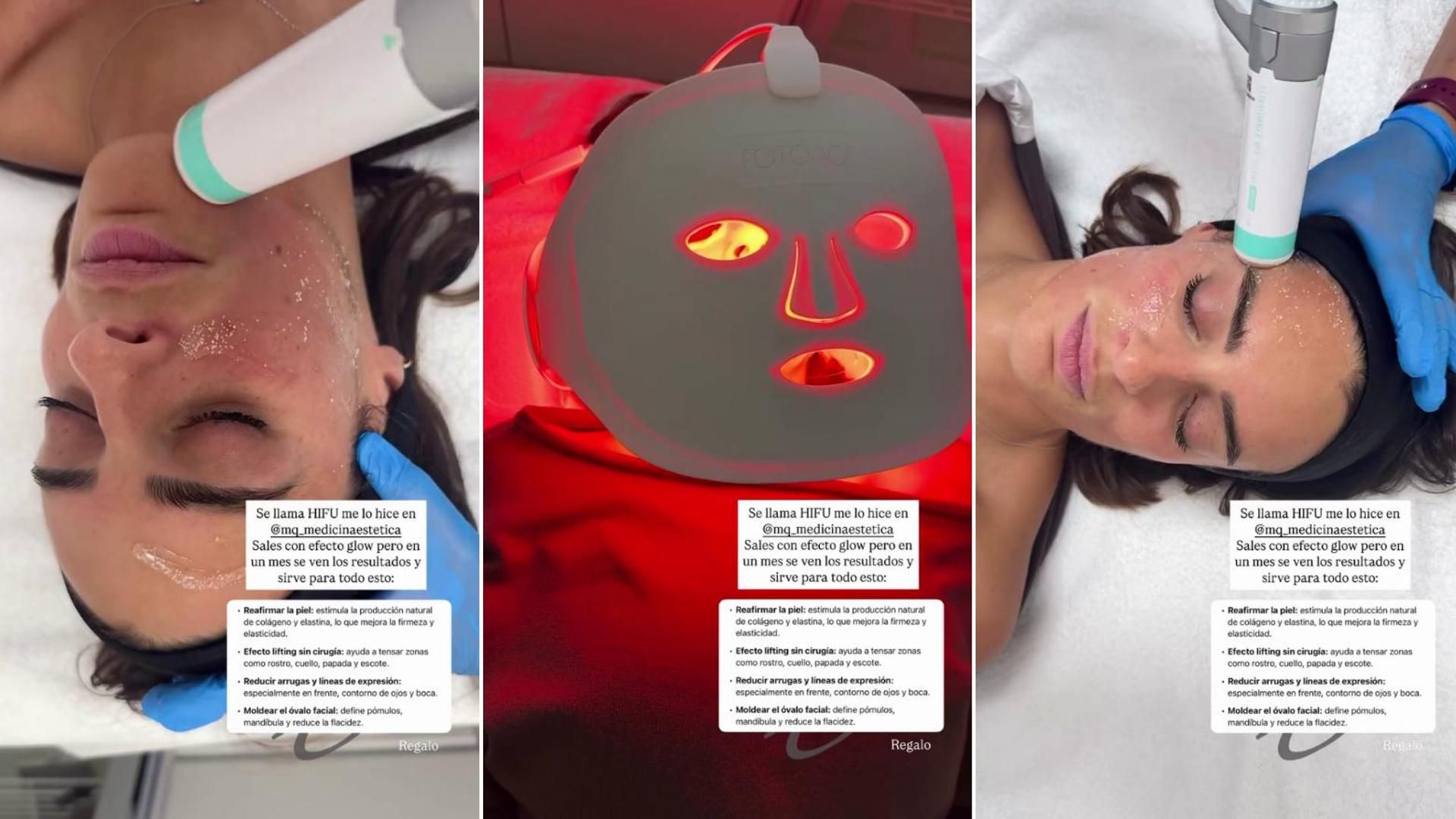 Así funciona el HIFU facial: Susana Molina muestra las diferentes fases del tratamiento