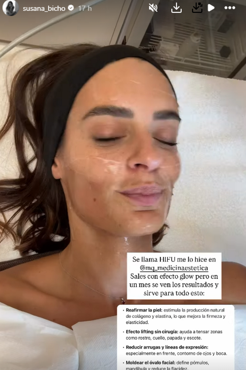 Susana Molina muestra el tratamiento para rejuvener el rostro al que se está sometiendo