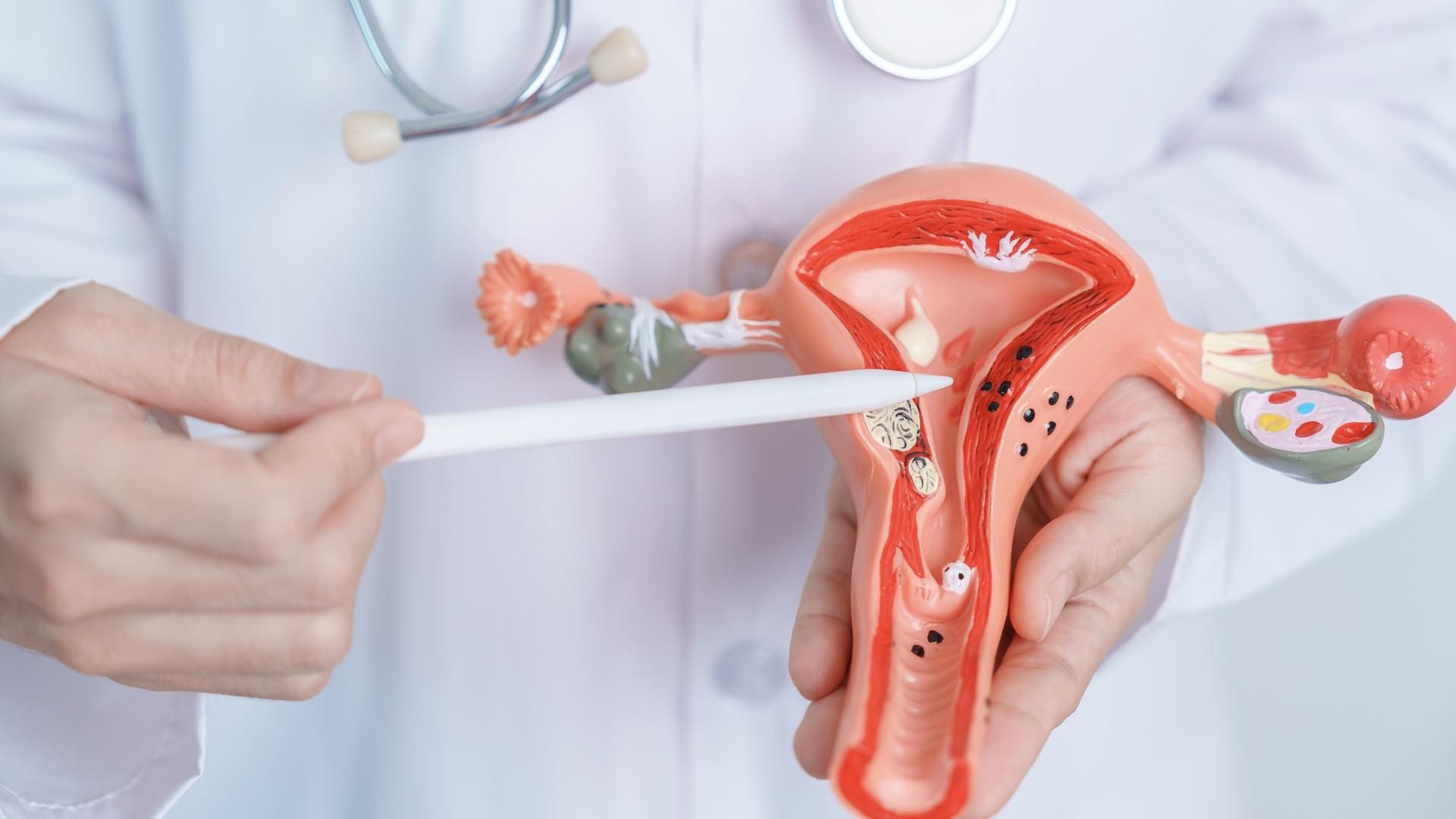 El cáncer de cuello uterino es uno de los más prevenibles