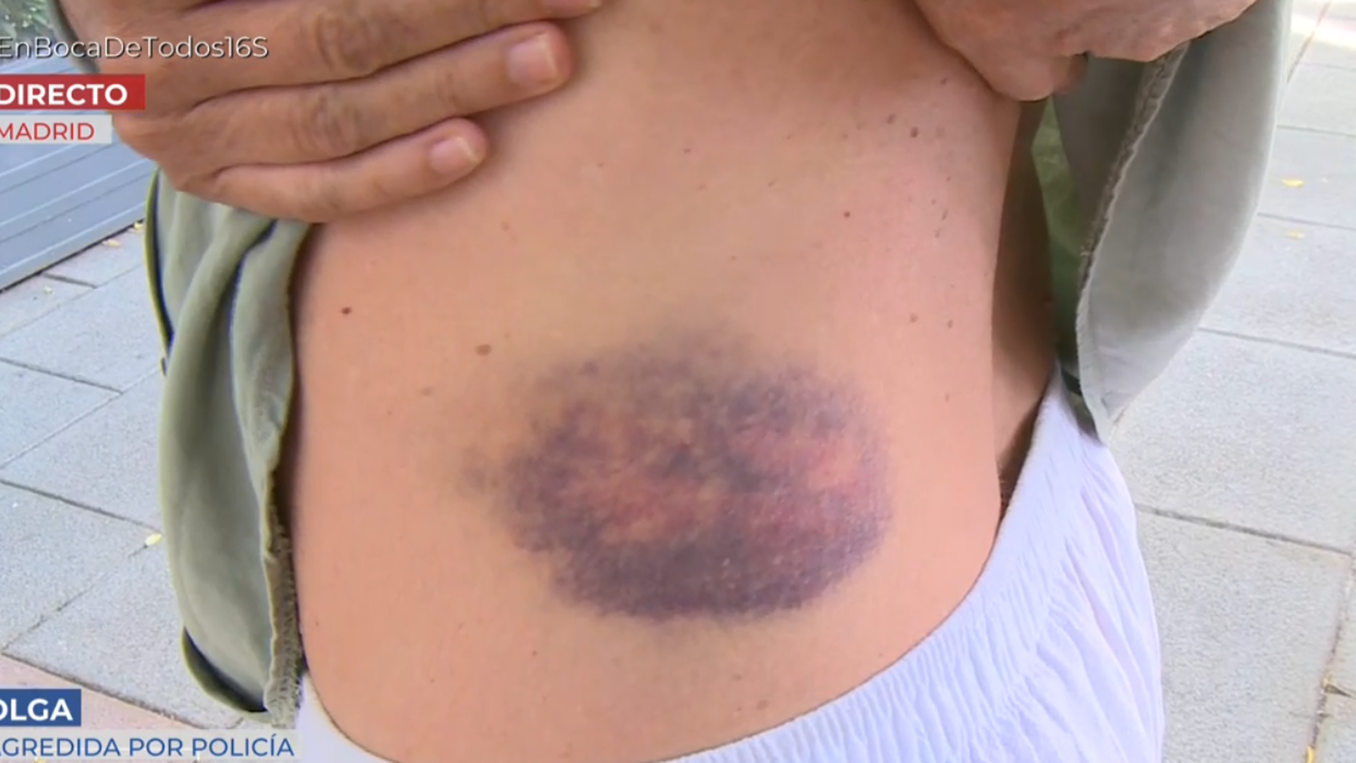 Las lesiones de Olga