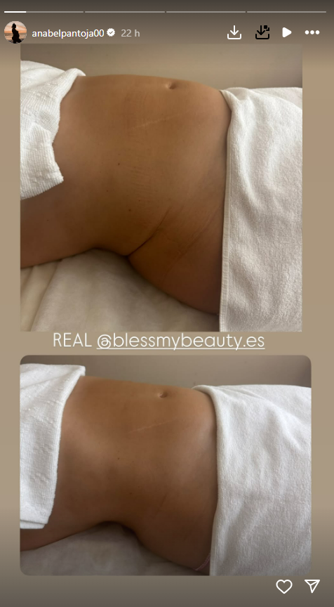 Anabel Pantoja enseña el impresionante cambio de su abdomen tras un masaje reductor