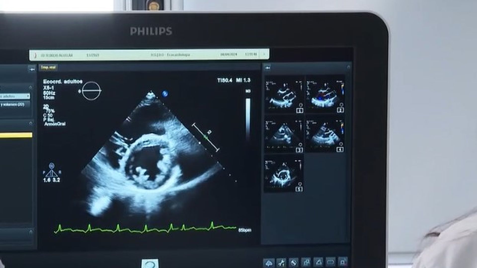La microcardiopatía hipertrófica, la principal causa de muerte súbita entre los jóvenes