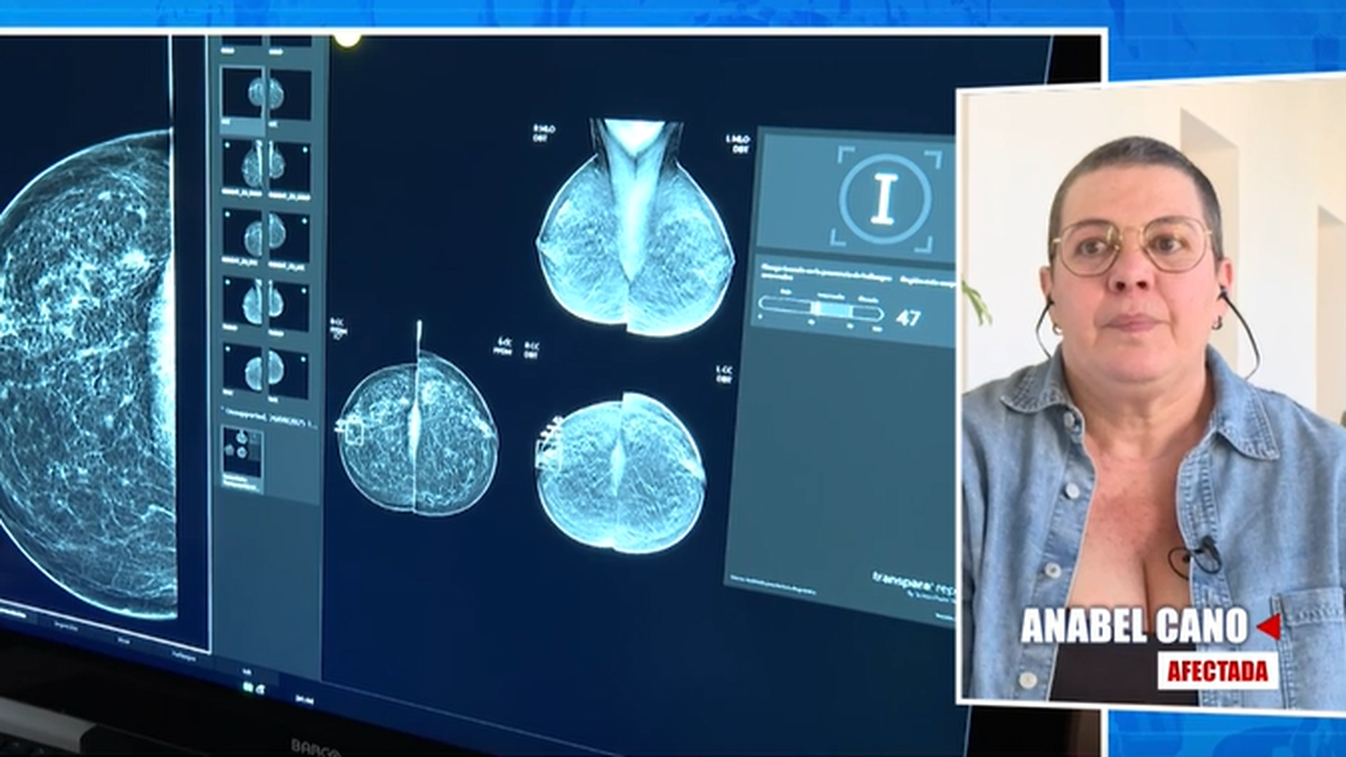 Una afectada de la prueba de detención del cáncer de mama del gobierno andaluz : "Nos están dejando morir" Una afectada de la prueba de detención del cáncer de mama del gobierno andaluz : "Nos están dejando morir"