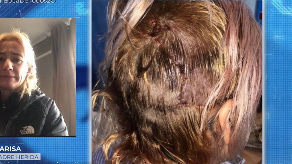 Una mujer, brutalmente atacada por dos perros tras proteger a su hijo de tres años: ''Me desgarró la cabeza''