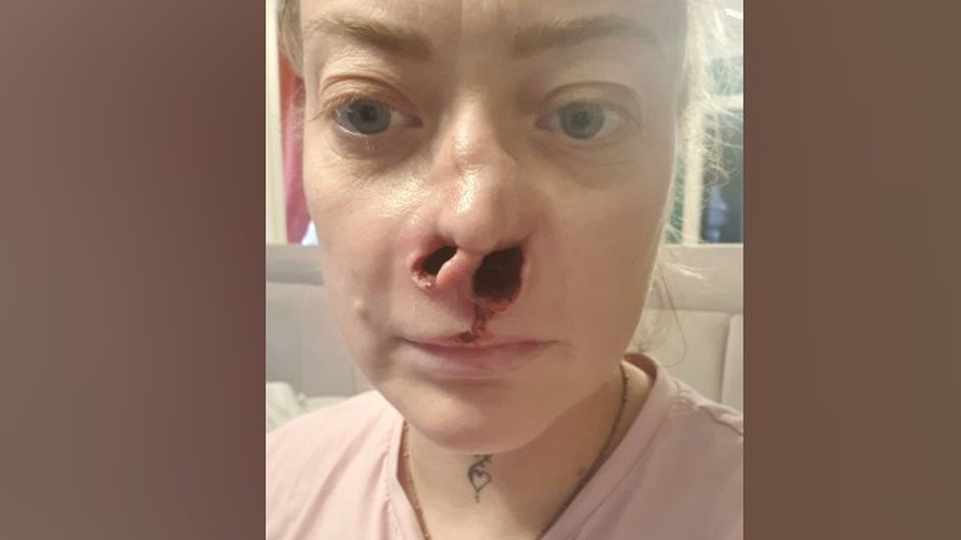 Un virus carnívoro destroza la nariz de una mujer tras una operación dental en Turquía: "Fue horrible"