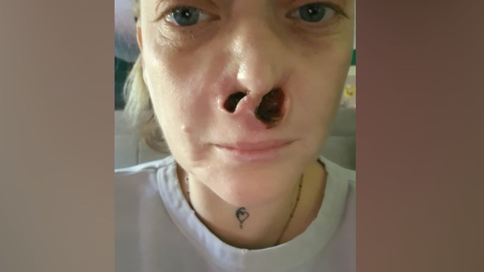 Un virus carnívoro ha destrozado la nariz de Leanne Abeyance