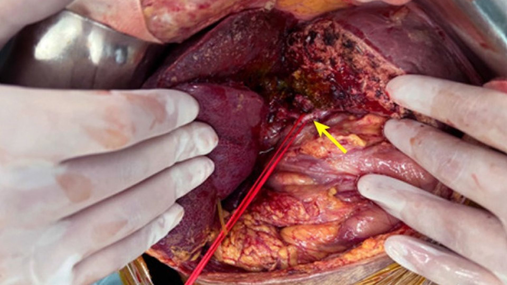 imágenes del órgano y los tejidos de cerdo trasplantados a un paciente en un hospital de China.