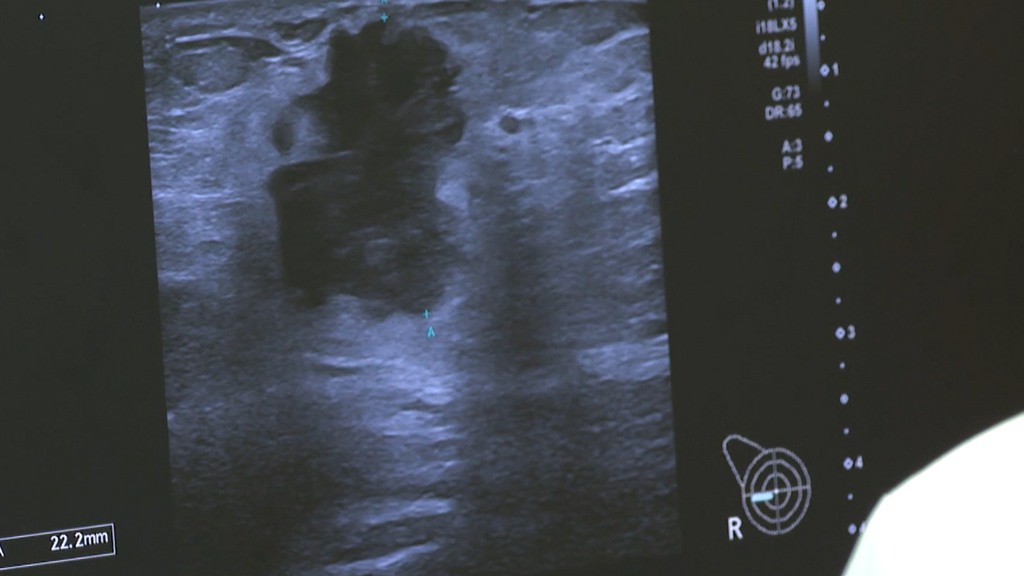 Las mujeres afectadas por el fallo de los cribados en Andalucía, sobre el plan de choque: "No nos creemos nada y llega tarde"