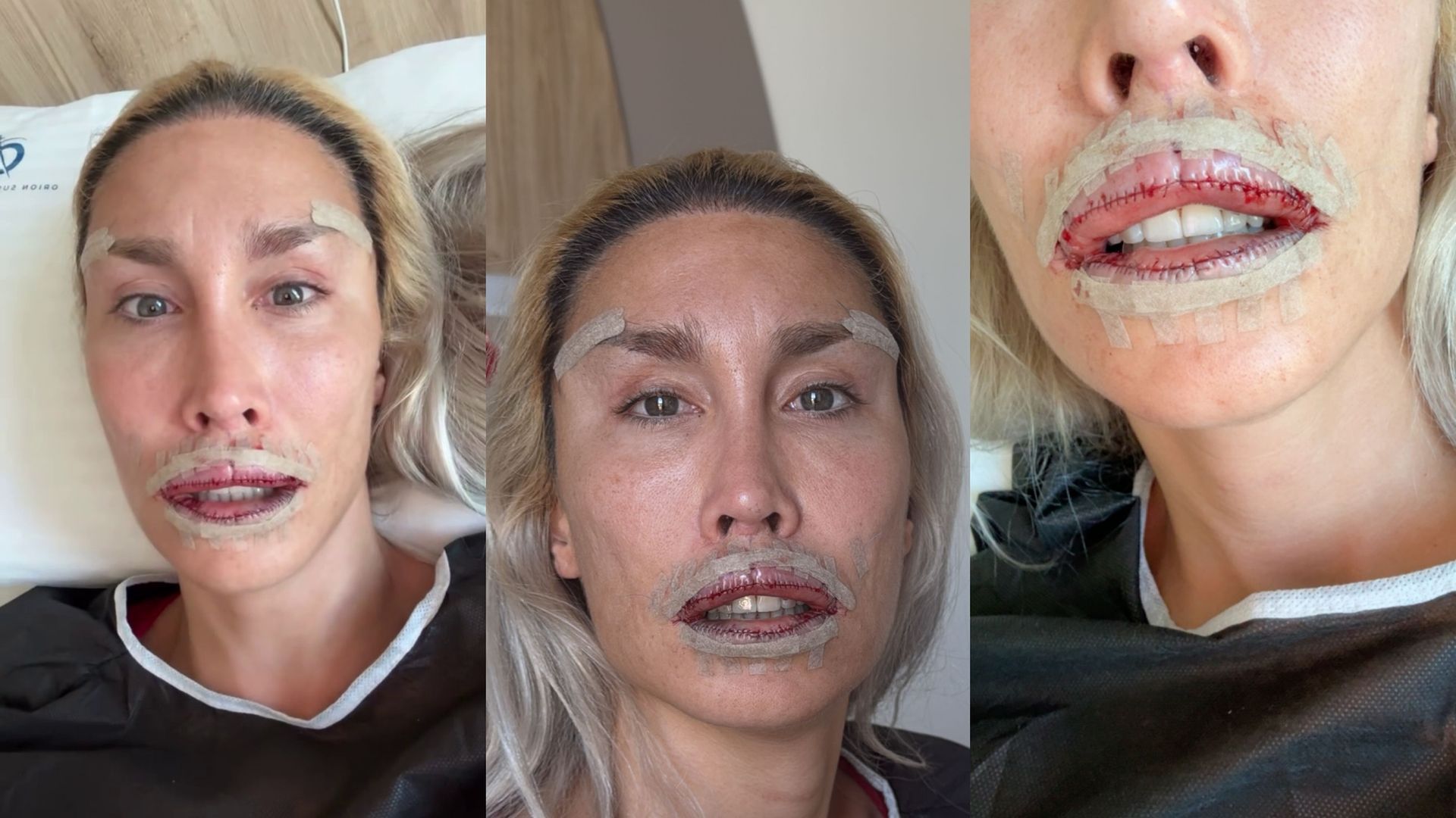 Las imágenes de La Pelopony con los labios cosidos