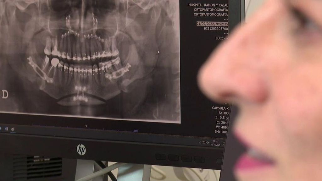 María y el calvario de padecer bruxismo: un hábito al alza y que condiciona la vida