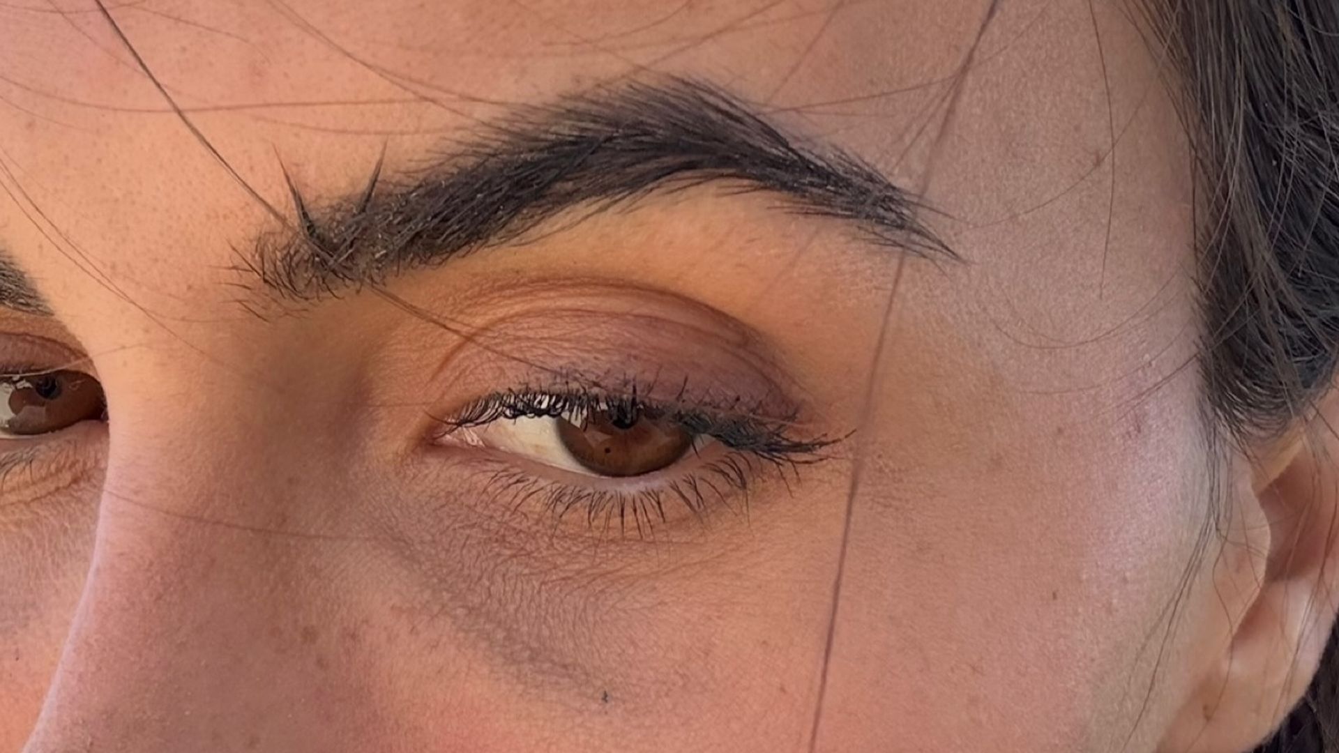 Sofía Suescun enseña el exceso de volumen que el ácido hialurónico había provocado en su ojera