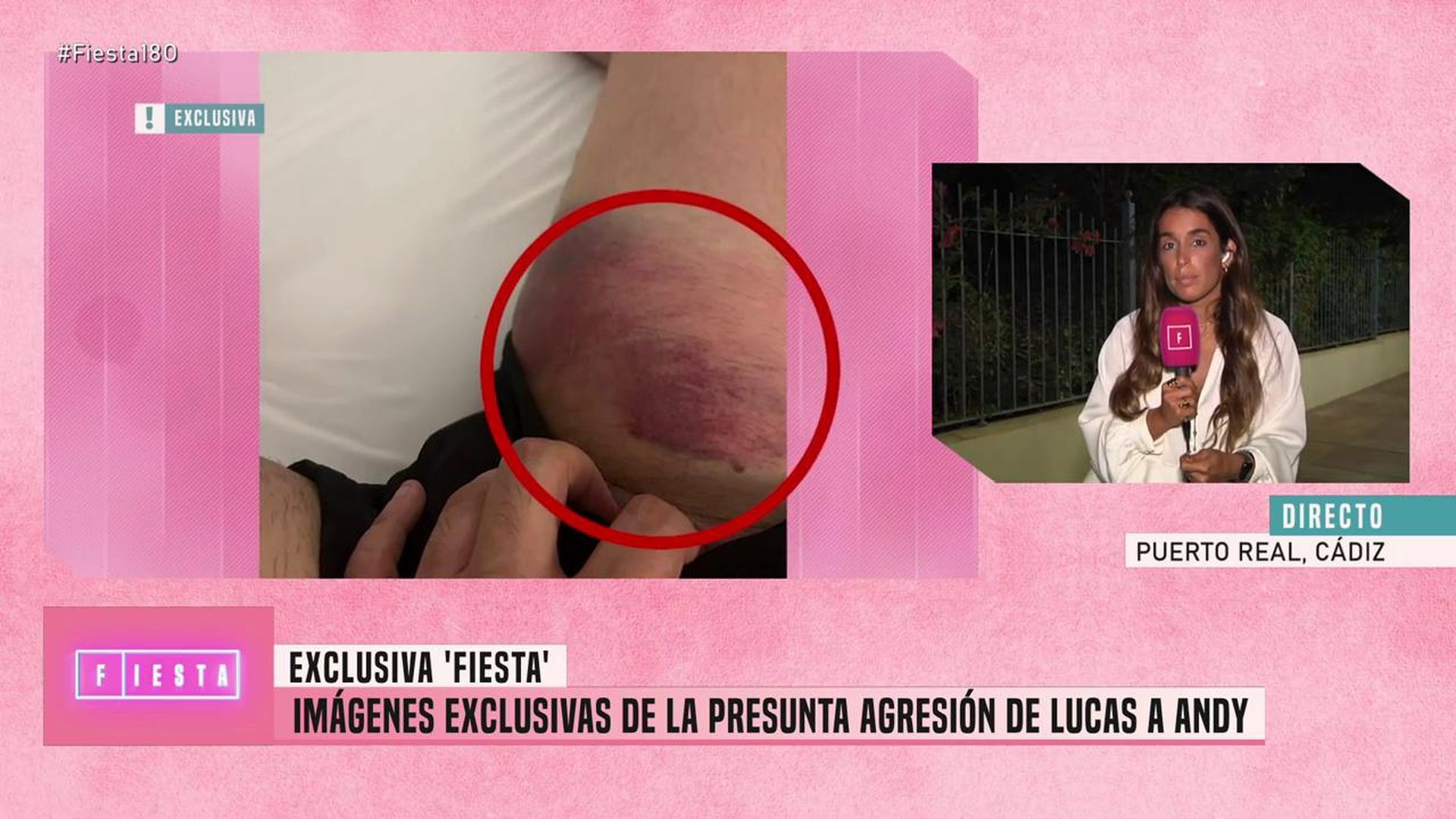 Andy muestra las heridas en su pierna tras su pelea con Lucas Fiesta 2025 Top Vídeos 865
