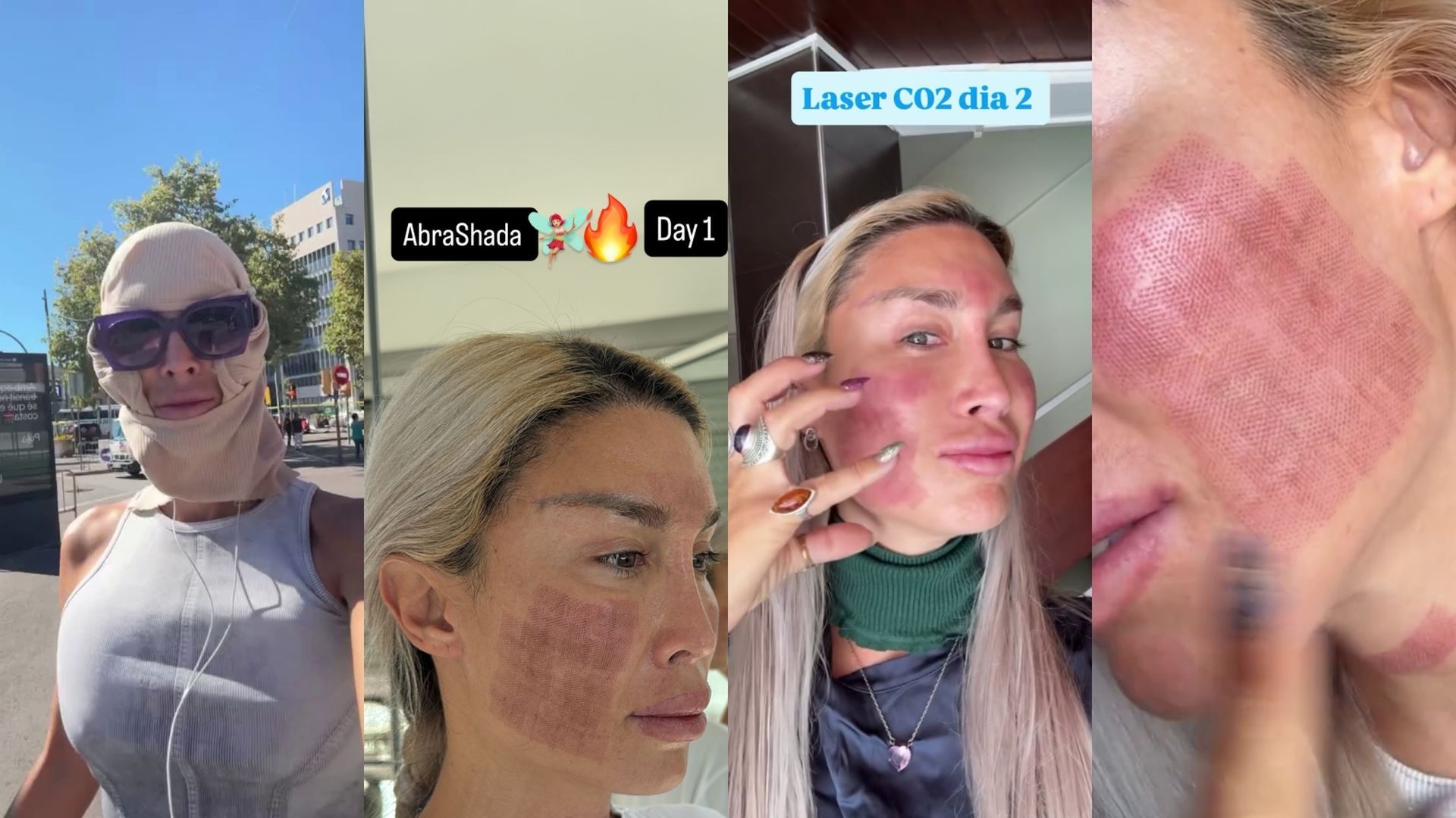 La Pelopony se somete a un nuevo tratamiento estético y reaparece con la cara completamente abrasada