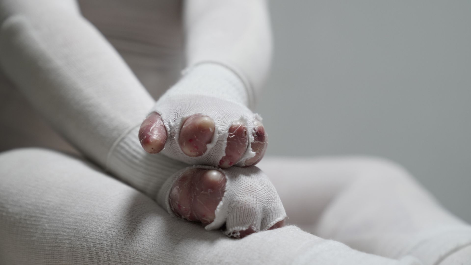 El cuerpo vendado de Victoria, una niña con piel de mariposa