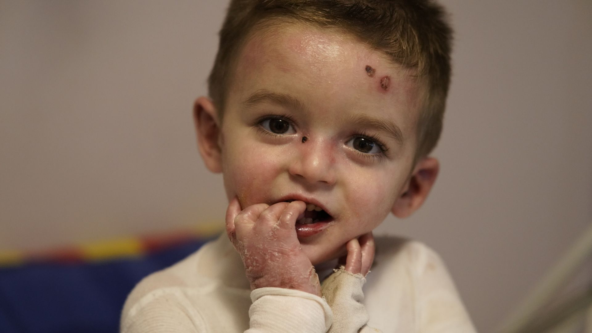 Campaña realizada por DEBRA para conseguir que el fármaco llegue a España