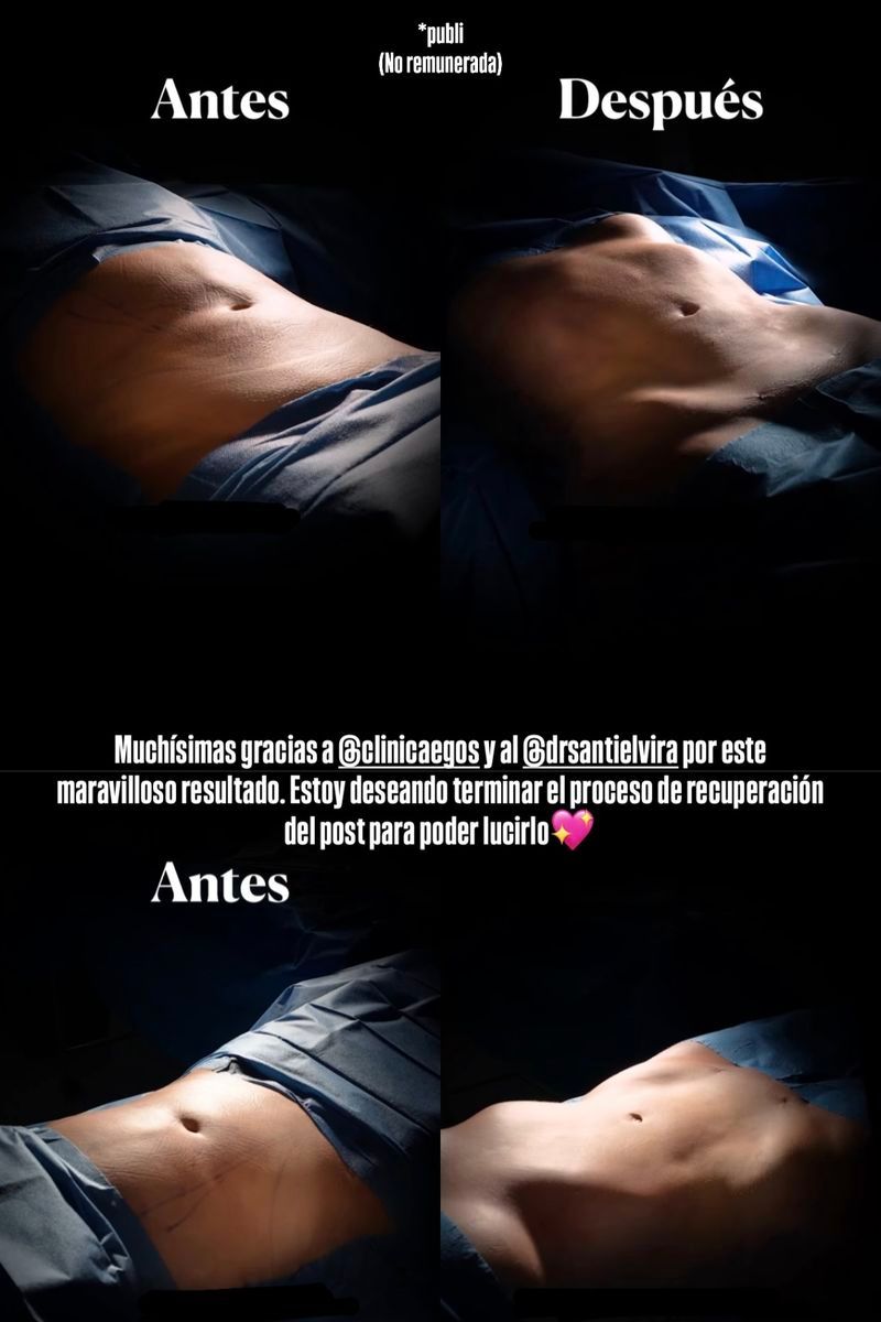 Lola Mencía muestras sus fotos del antes y el después de su segunda liposucción