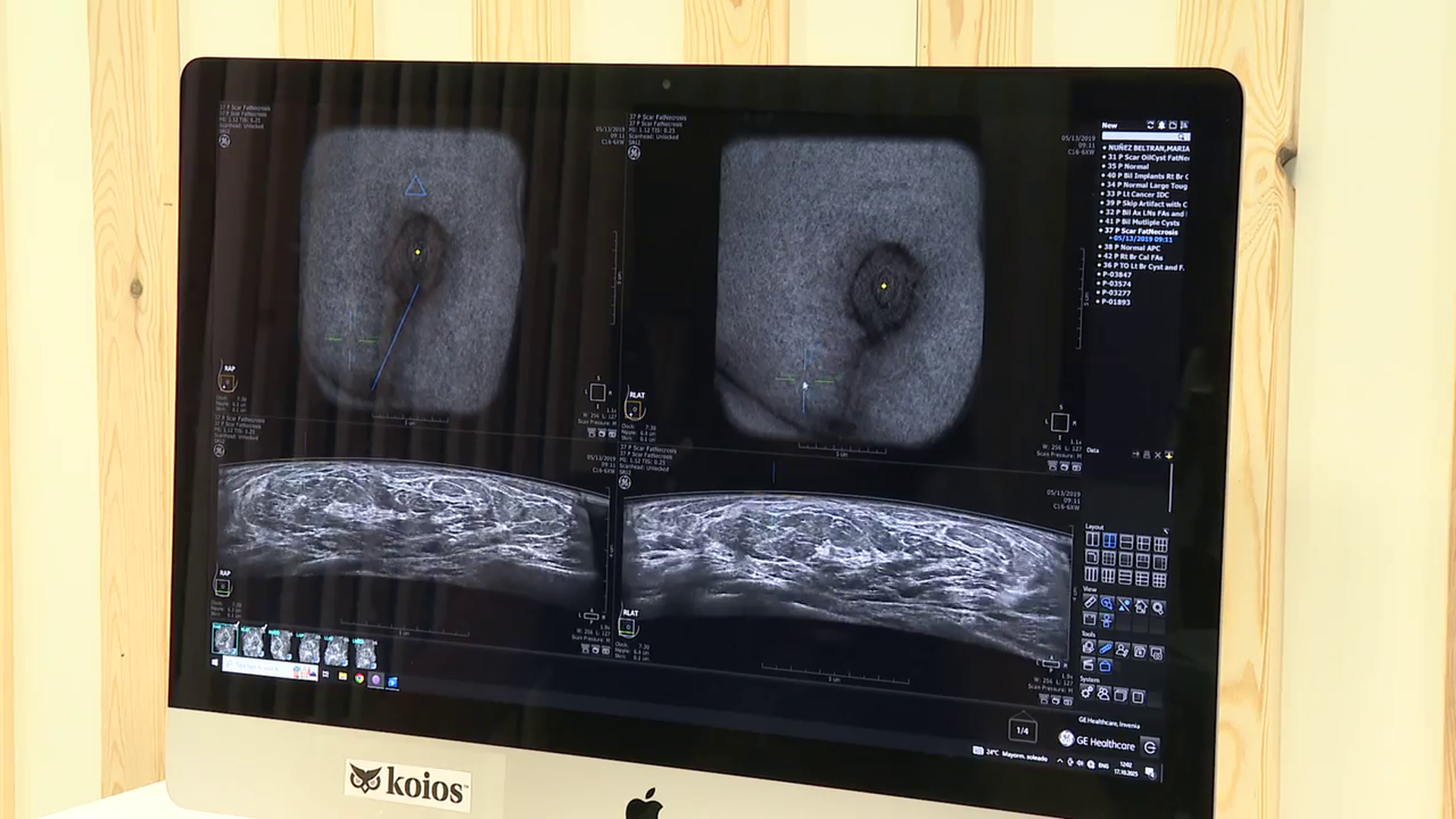¿Qué falló en el sistema de cribados de cáncer de mama de Andalucía?