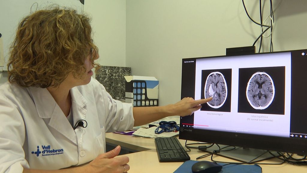 Una experta explica qué es un ictus