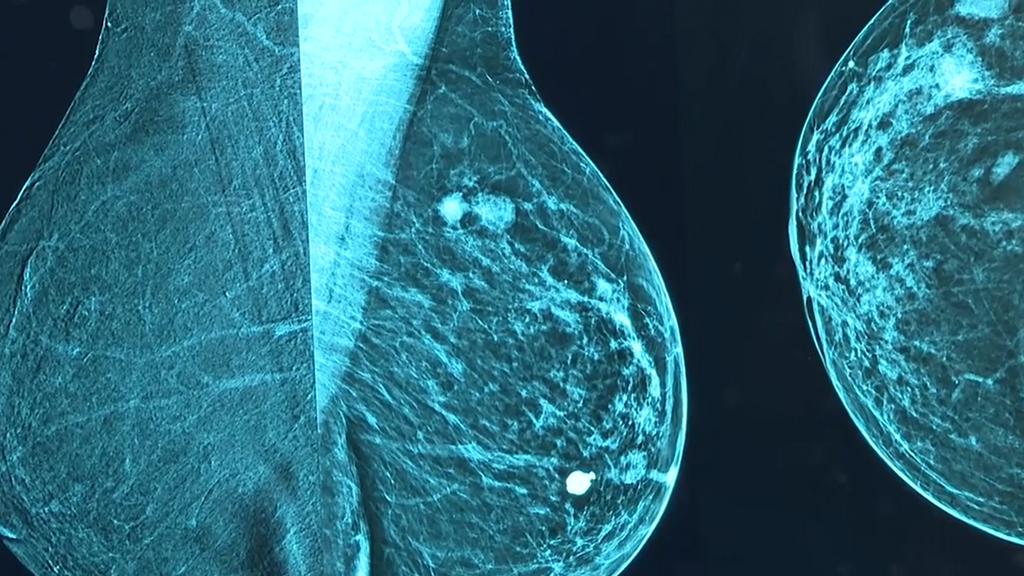 La crisis de los cribados del cáncer en Andalucía sigue sin respuestas