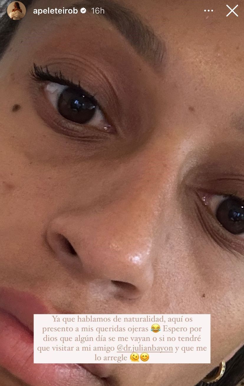  Ana Peleteiro mostrando sus "queridas ojeras" en Instagram (@apeleteiroob)