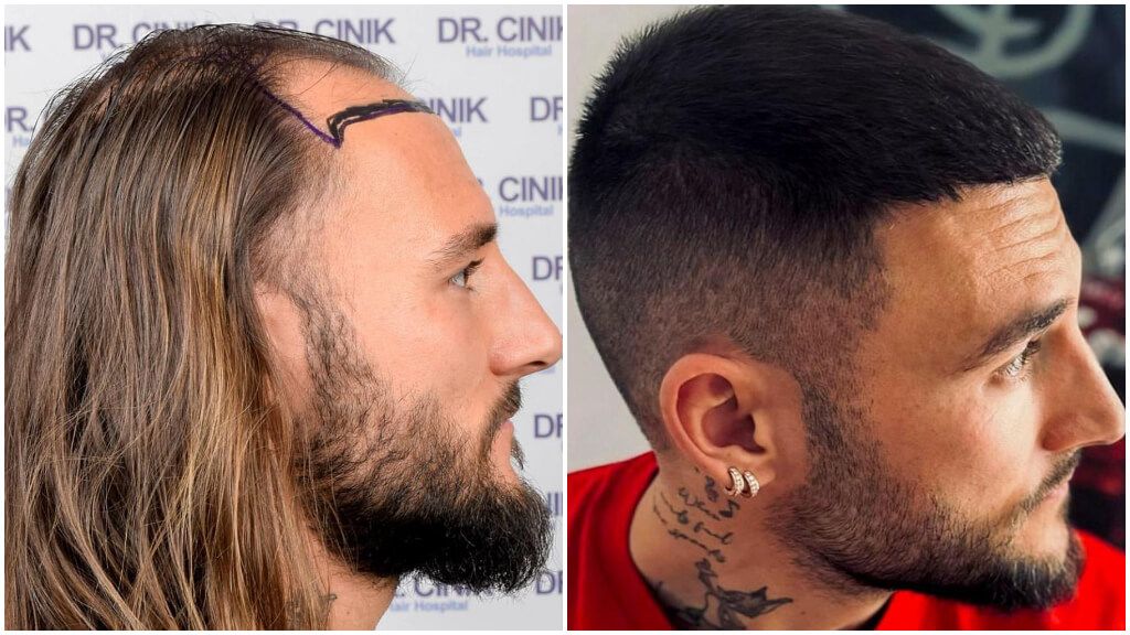 Nemanja Gudelj y su proceso de injerto capilar.