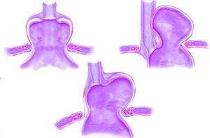 Tipos de hernia de hiato: por deslizamiento, paraesofágica y mixta. (Revista Farmacia Profesional)