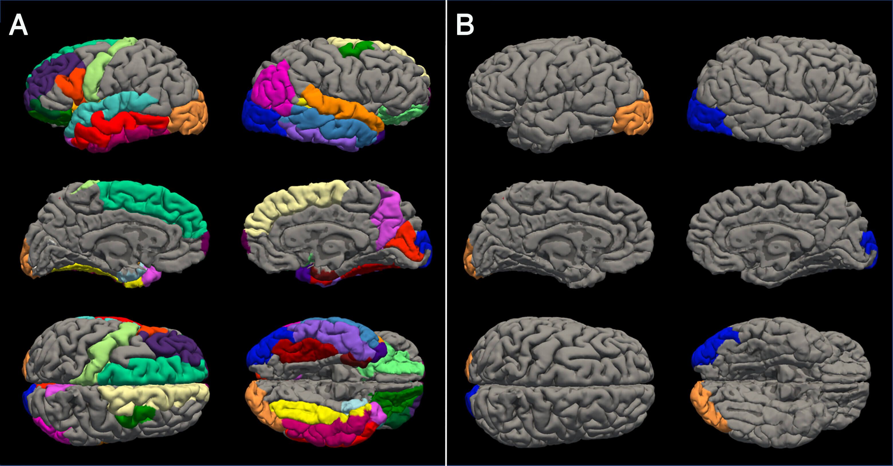Regiones con un adelgazamiento cortical significativamente acelerado en el cerebro de adolescentes después del confinamiento por COVID-19. A (mujeres) y B (hombres)