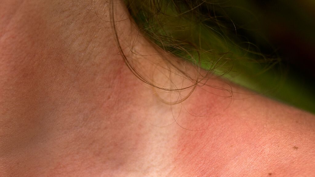  Cuello y hombro enrojecido