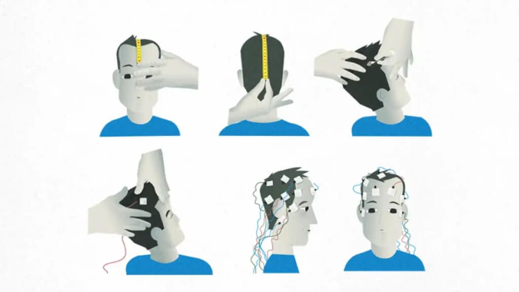  Colocación de los electrodos para realizar un electroencefalograma