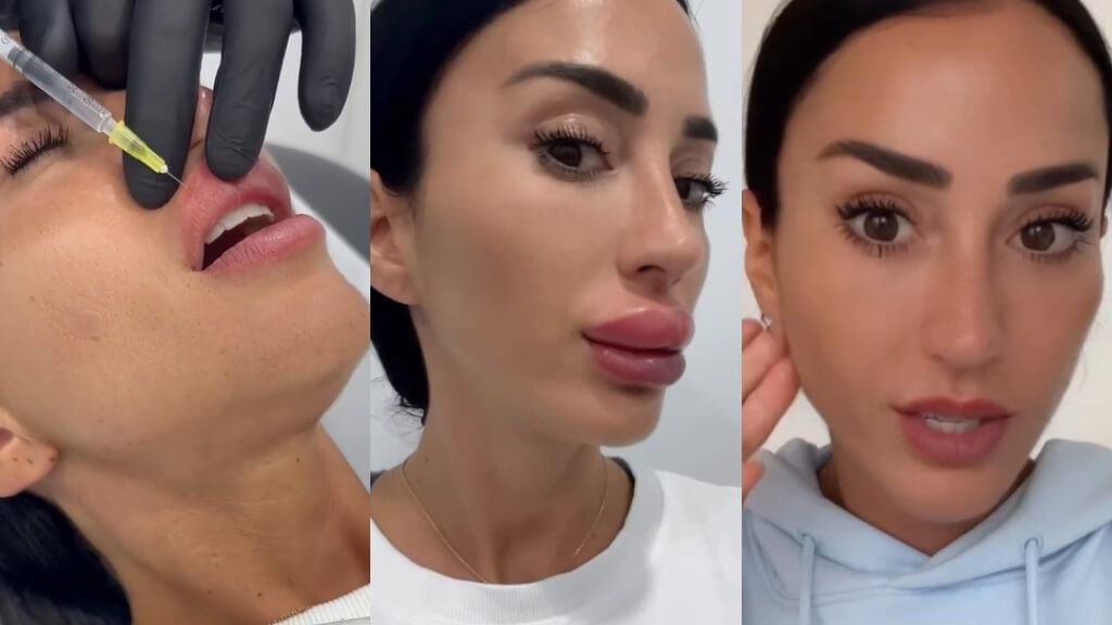  Antes y después de Aurah Ruiz tras quitarse los labios