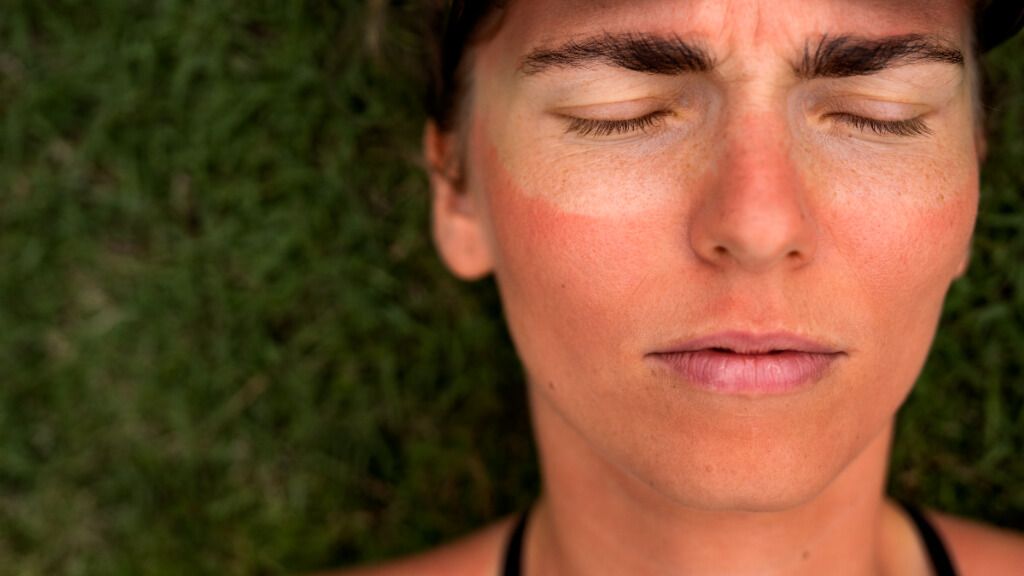  Mujer con la cara quemada por el sol