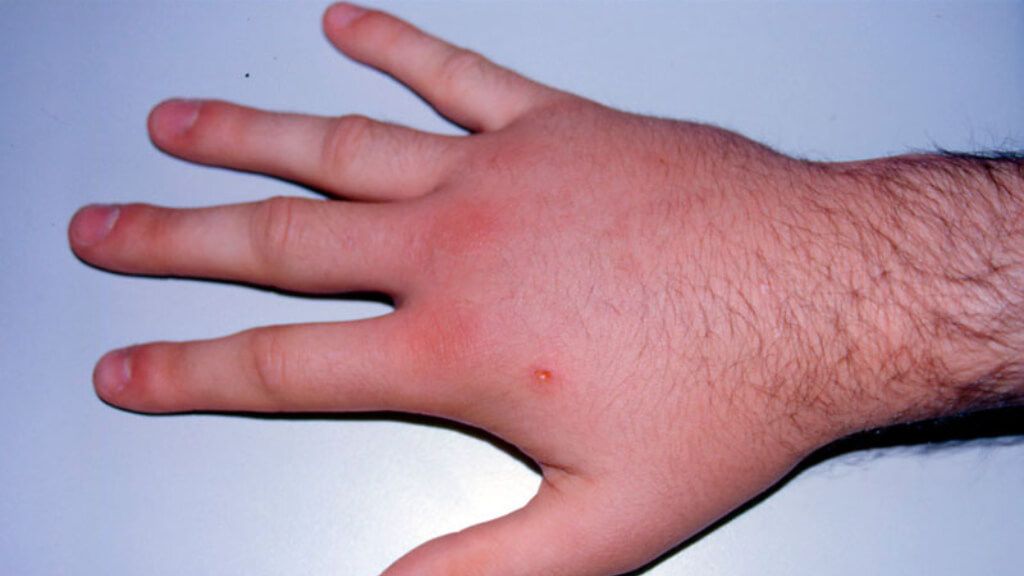 Reacción local extensa de una picadura de abeja o de avispa en la mano (SEAIC)