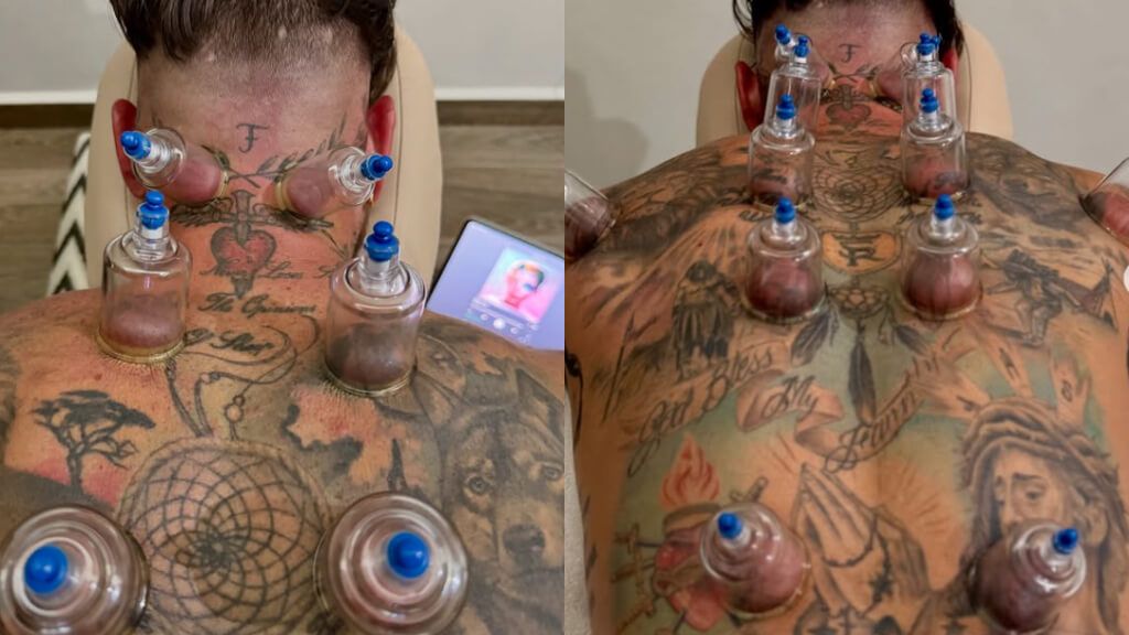  Sergio Ramos sometiéndose a la terapia de ventosas