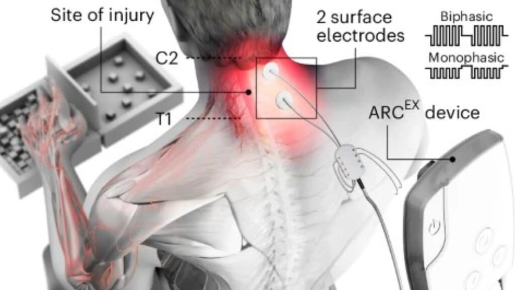  Descripción general del funcionamiento de la terapia ARCEX (Nature Medicine)